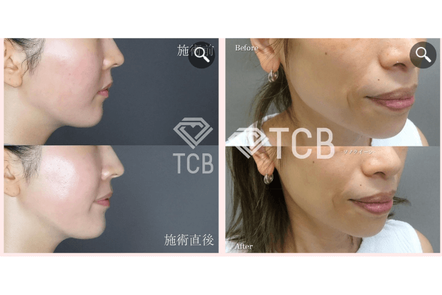 TCB東京中央美容外科　ハイフの症例写真