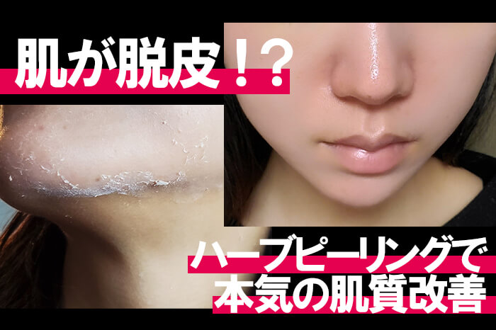 たった5日で肌が脱皮 本気で肌質改善したい編集部員が ハーブピーリング を体験 Girlswalker ガールズウォーカー
